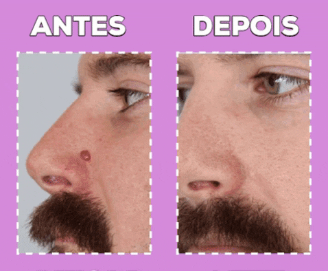 Cauterizador de verrugas/ PANTALLA LED