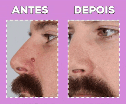 Cauterizador de verrugas/ PANTALLA LED