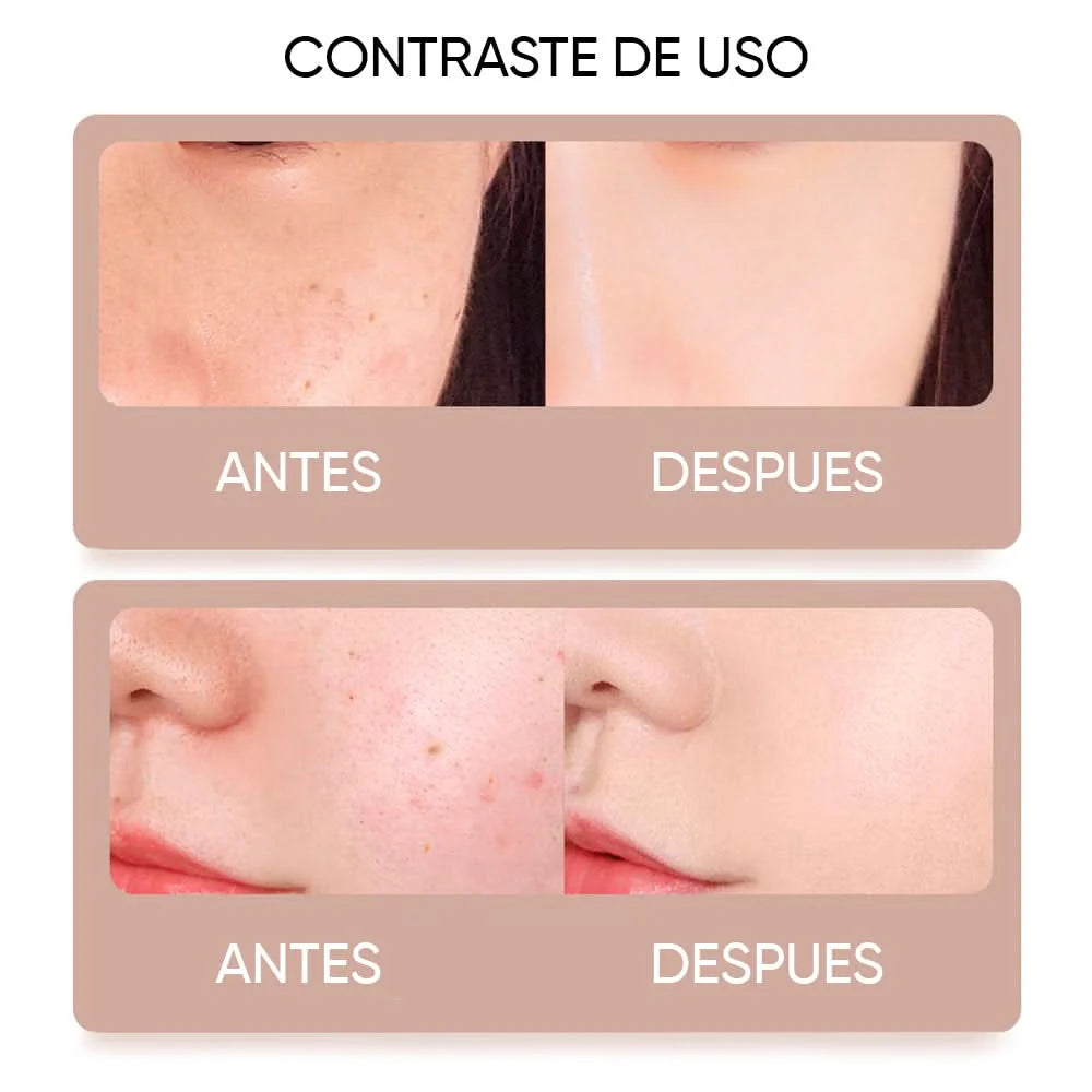 Cauterizador de verrugas/ PANTALLA LED