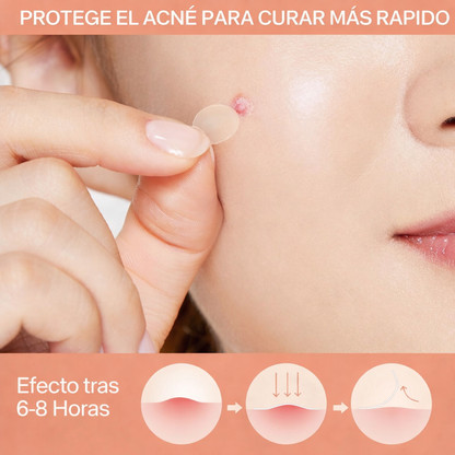 PARCHES ANTI ACNE X 144