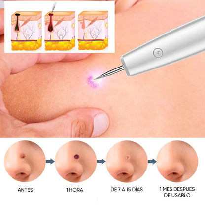 Cauterizador de verrugas/ PANTALLA LED