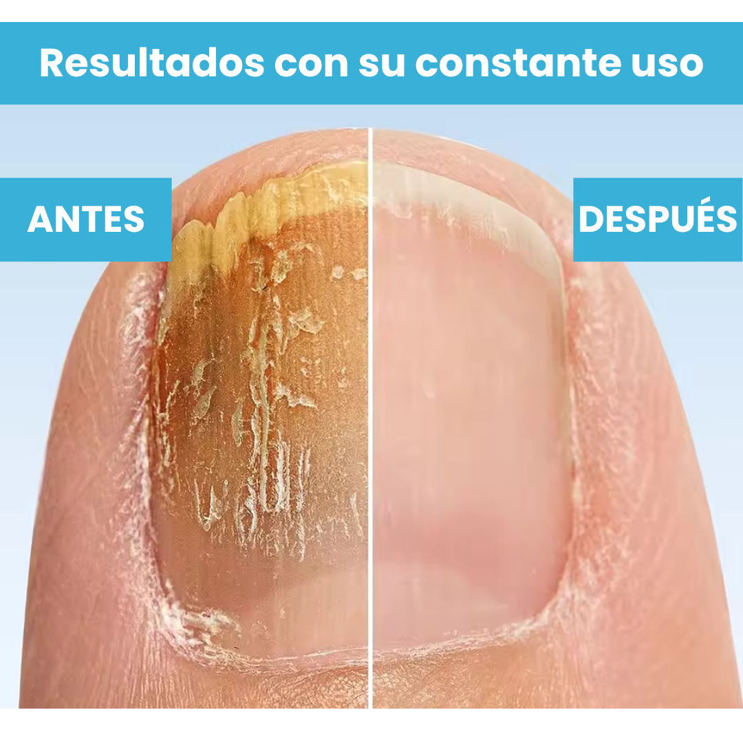 LASER ELIMINA HONGOS UÑAS