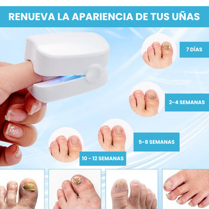 LASER ELIMINA HONGOS UÑAS